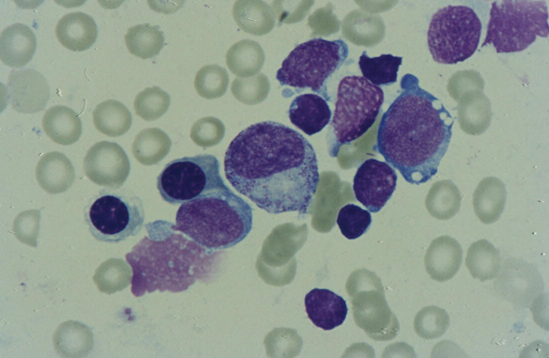 Photo depicts dyserythropoietic erythroblasts in the bone marrow of a neonate with Pearson syndrome showing prominent vacuolation of a proerythroblast.