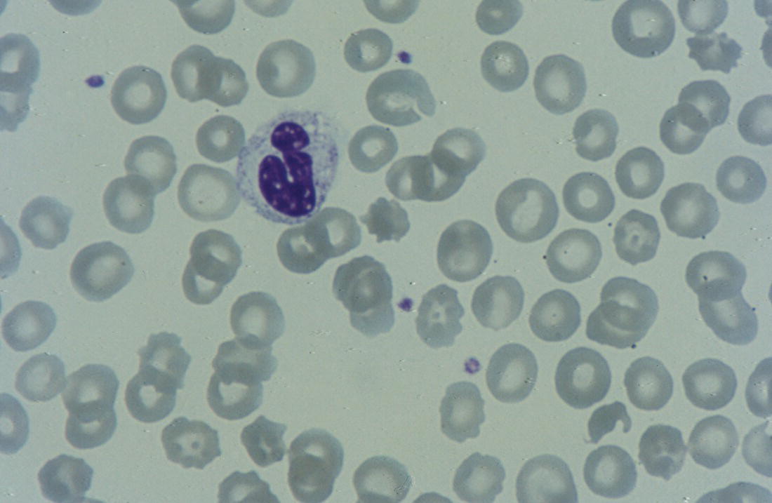 Photo depicts peripheral blood film of a neonate with Pearson syndrome showing vacuolation in a dysplastic neutrophil.