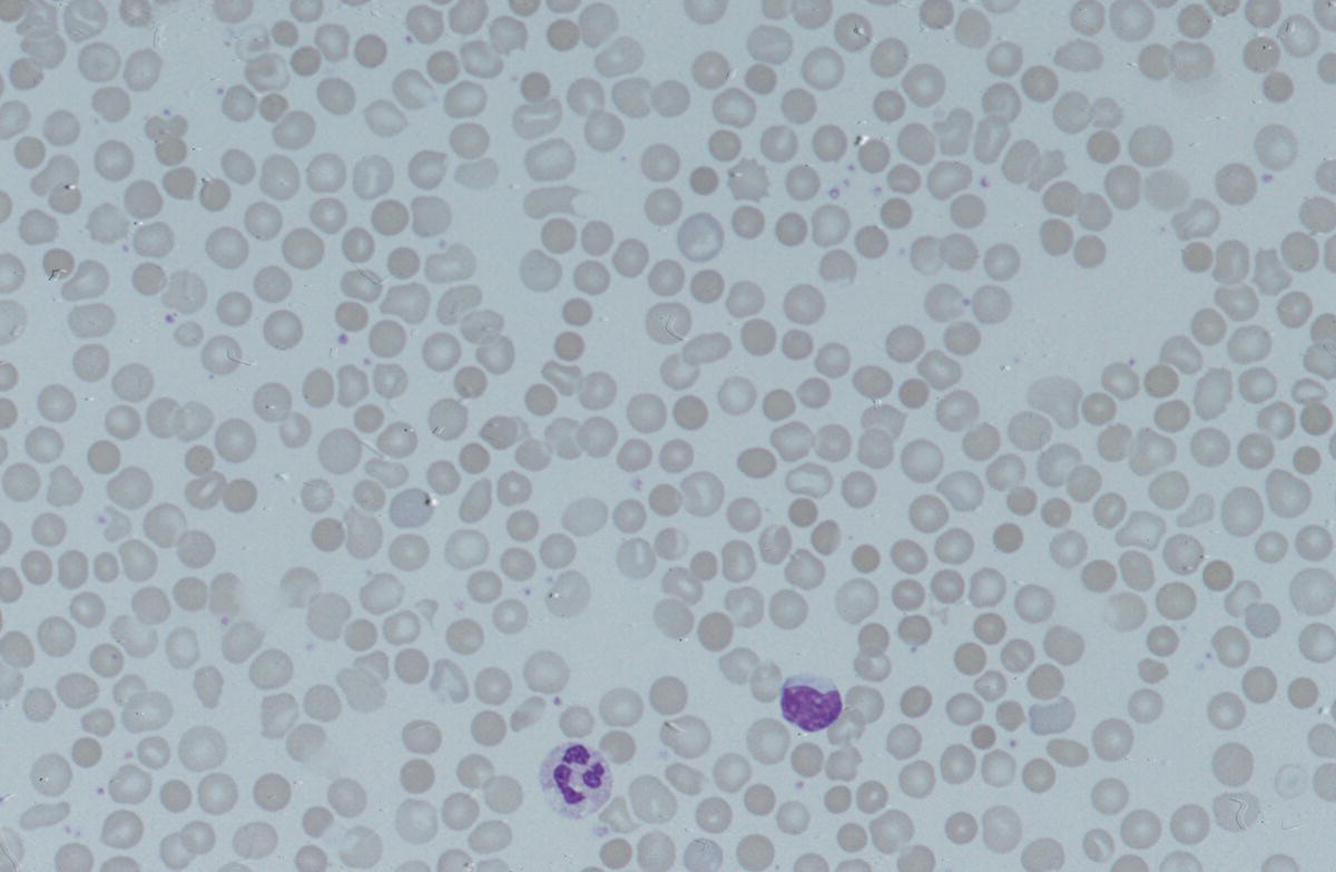 Photo depicts peripheral blood film of a neonate with Pearson syndrome showing a dysplastic neutrophil with vacuolation.