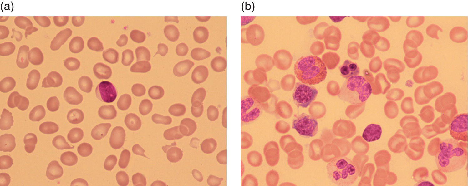 Photo depicts congenital dyserythropoietic anaemia.