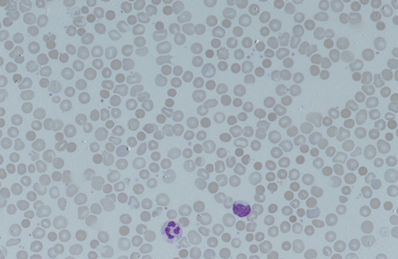 Photo depicts typical blood film of a term neonate with ABO haemolytic disease of the fetus and newborn (HDFN) showing large numbers of spherocytes.