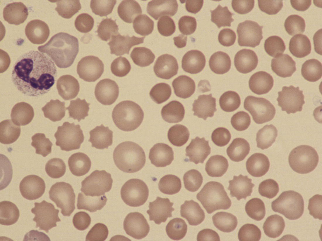 Photo depicts a blood film of a preterm neonate with ABO HDFN showing large numbers of spherocytes as well as some macrocytes, echinocytes and polychromasia.