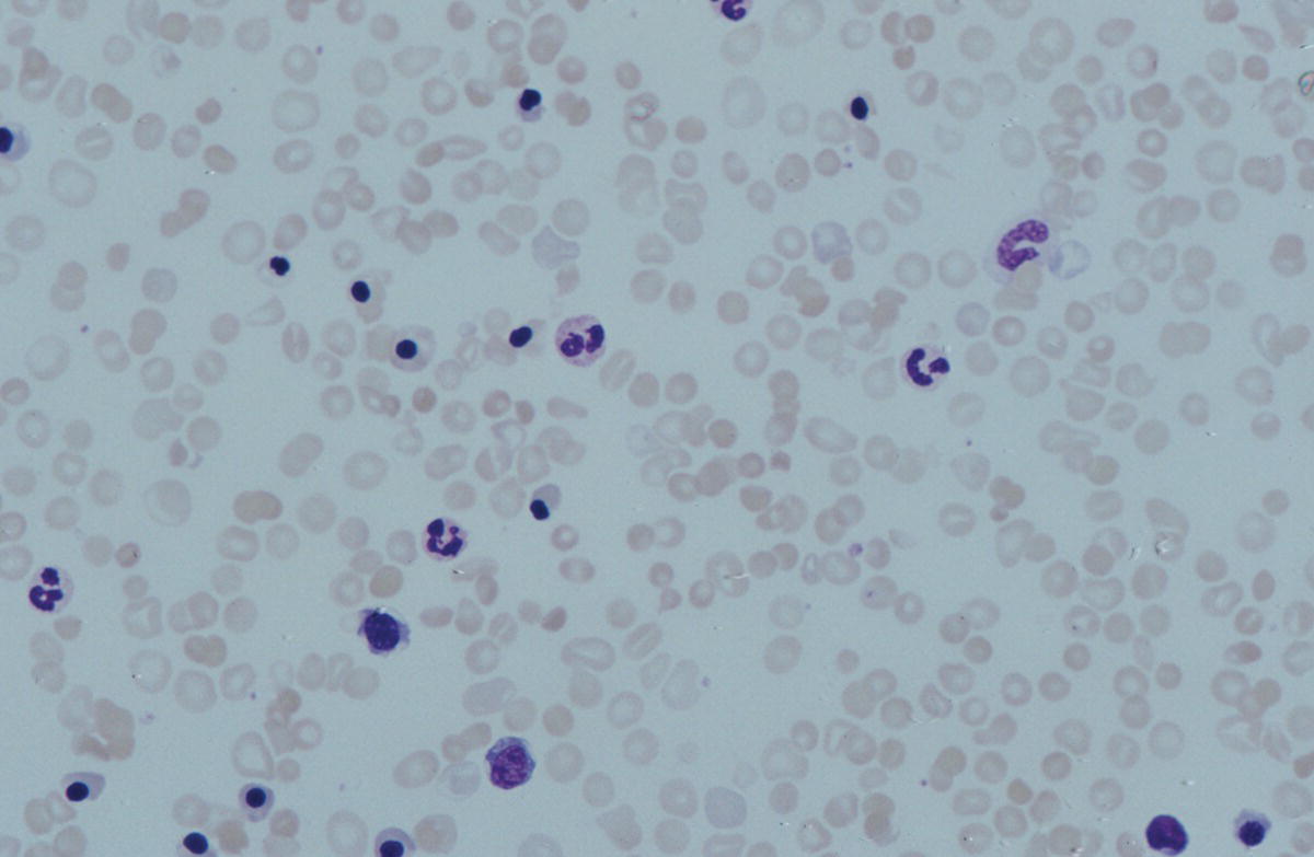 Photo depicts a blood film of a term neonate with severe Rh HDFN showing large numbers of NRBC, including two early normoblasts, polychromasia and some spherocytes.