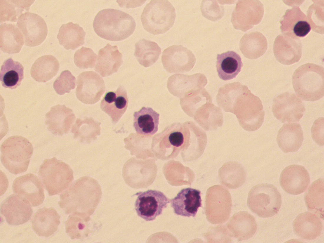 Photo depicts a blood film of a preterm neonate with Rh HDFN showing large numbers of erythroblasts, including several dyserythropoietic cells, and marked polychromasia.