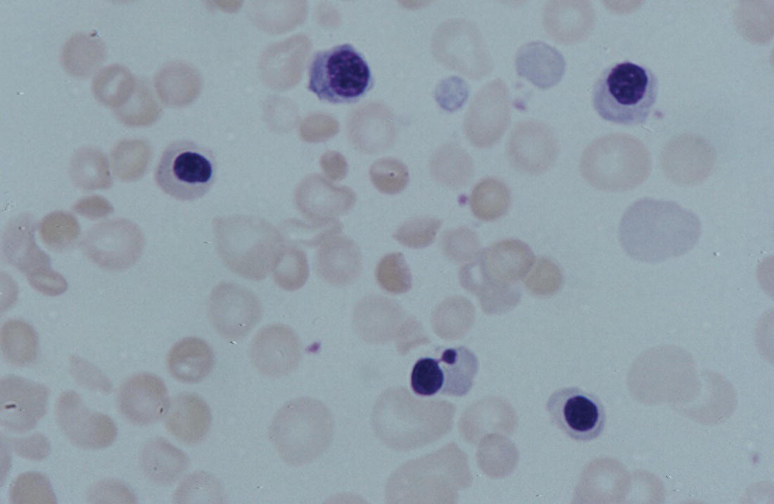 Photo depicts a blood film of a term baby with severe Rh HDFN showing dyserythropoietic NRBC.