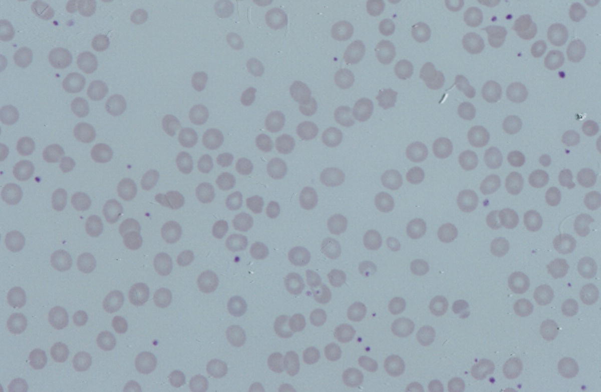 Photo depicts a blood film of a neonate with hereditary spherocytosis showing spherocytes and one button-mushroom poikilocyte.