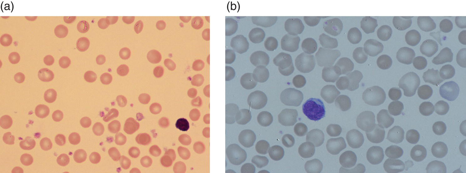 Photo depicts (a) Blood film of a neonate with hereditary spherocytosis showing moderate numbers of spherocytes. (b) Blood film of a neonate with ABO HDFN showing almost identical appearance with moderate numbers of spherocytes.