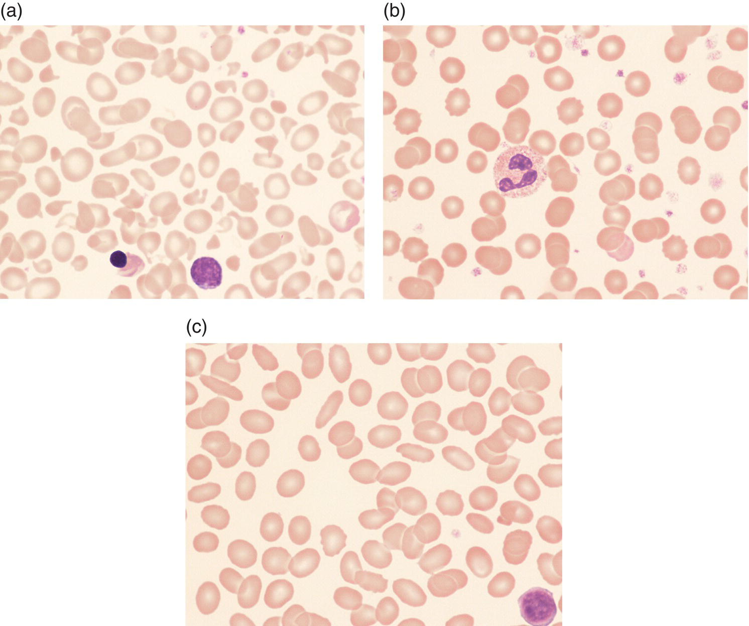 Photo depicts blood films of a neonate with hereditary pyropoikilocytosis and her parents.