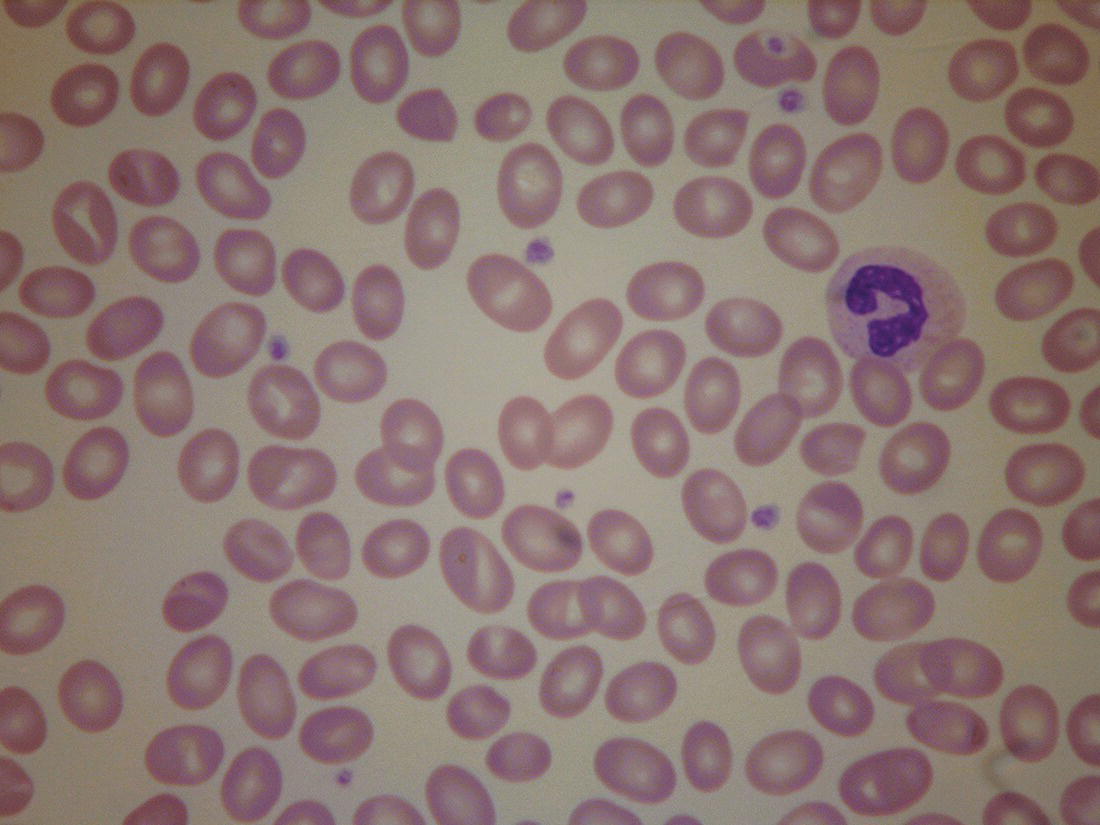 Photo depicts a blood film of an older patient with Southeast Asian ovalocytosis showing ovalocytes, macro-ovalocytes and distinctive stomatocytes.