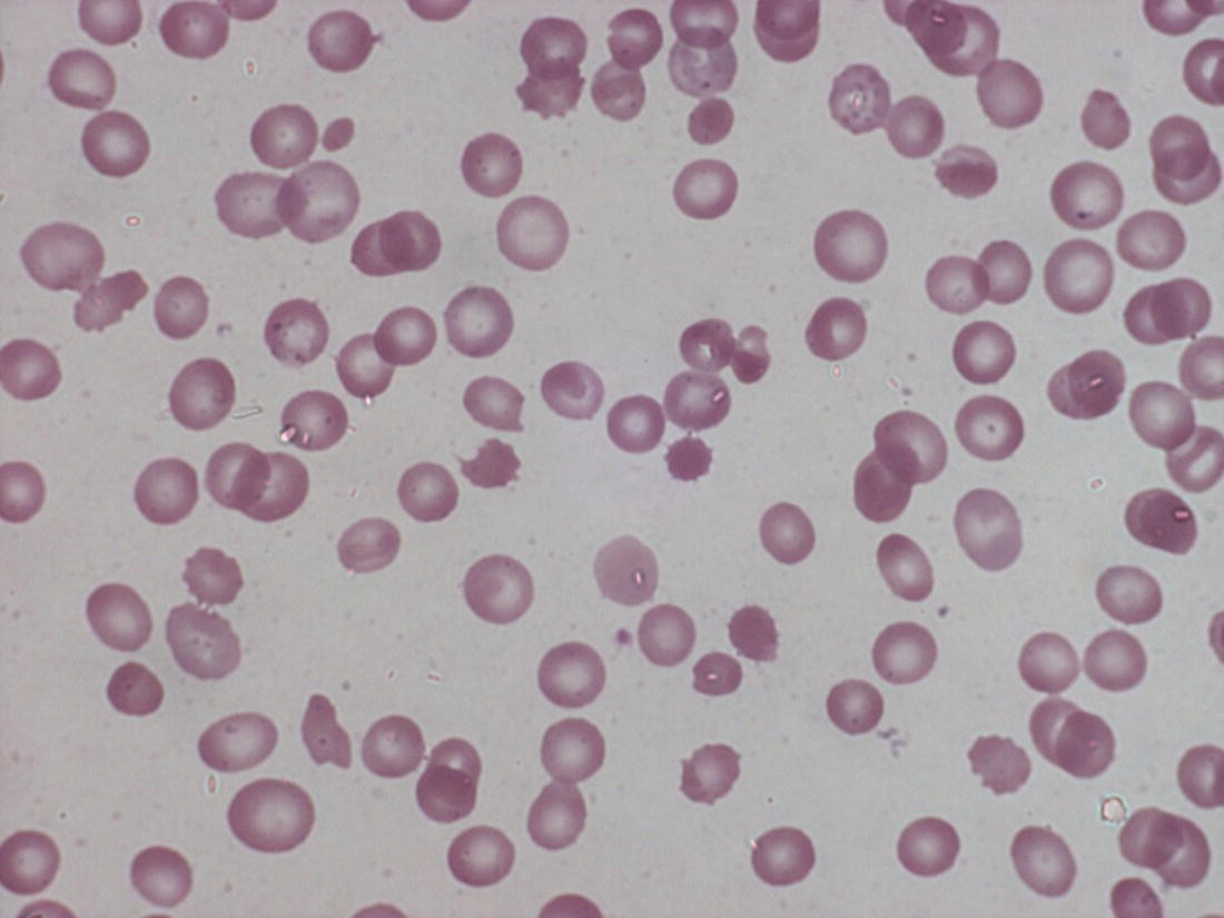 Photo depicts a blood film of a neonate with oxidative haemolysis due to glucose-6-phosphate dehydrogenase (G6PD) deficiency showing irregularly contracted cells and a bite cell.