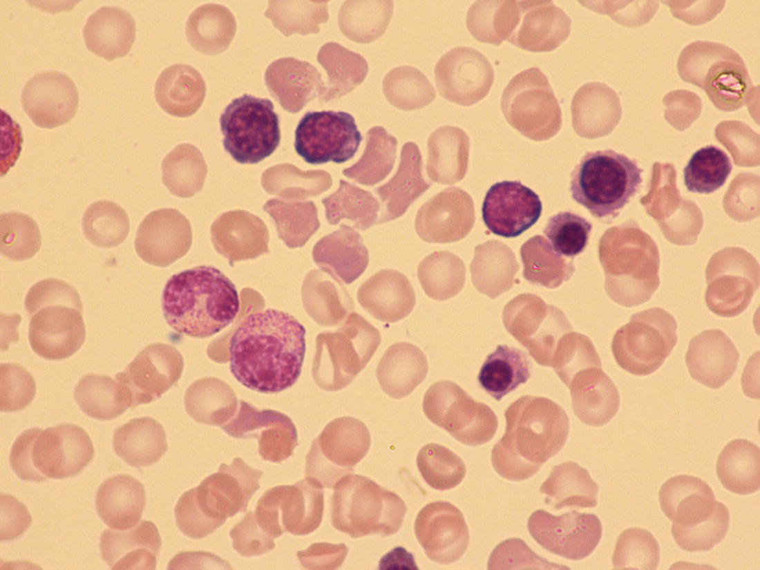 Photo depicts a blood film of a neonate with pyruvate kinase (PK) deficiency showing marked erythroblastosis and polychromasia and occasional echinocytes.