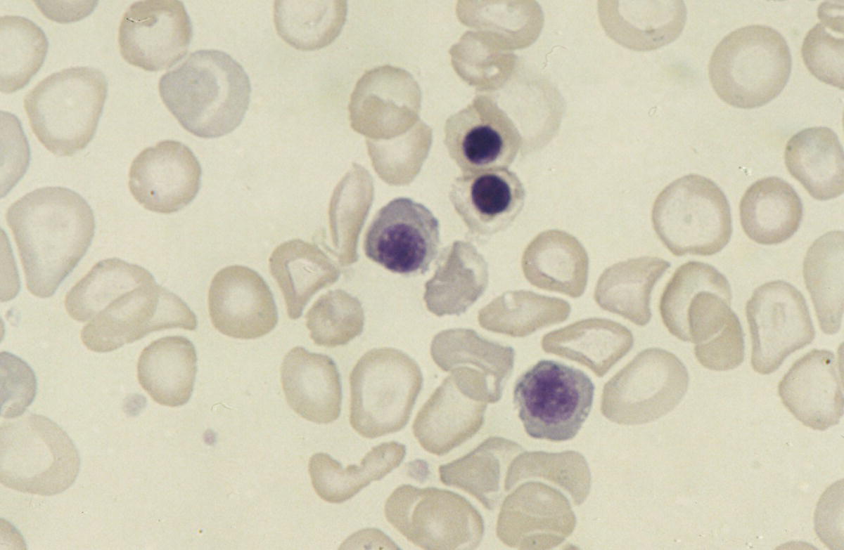 Photo depicts a blood film of a preterm neonate with haemoglobin Bart’s hydrops fetalis on day 1 of life showing markedly hypochromic red cells, many of which are microcytic, as well as polychromasia and four NRBC.