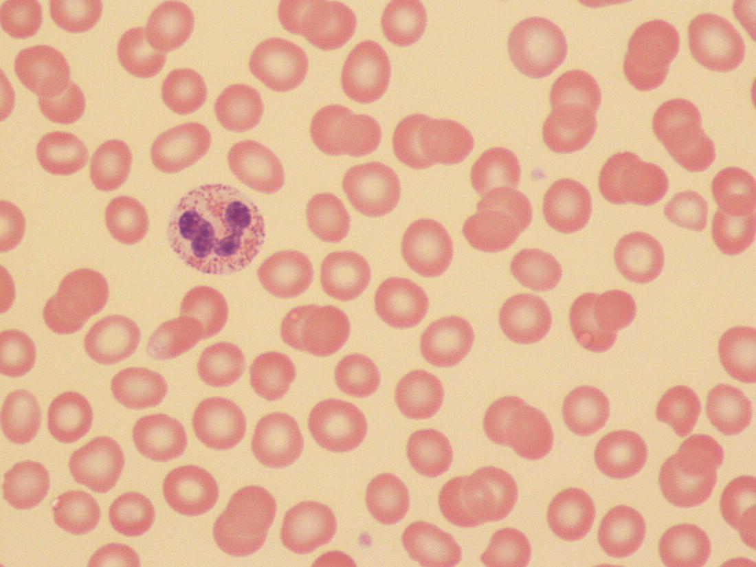 Photo depicts a blood film of the mother of the neonate whose film shows microcytosis and mild hypochromia..