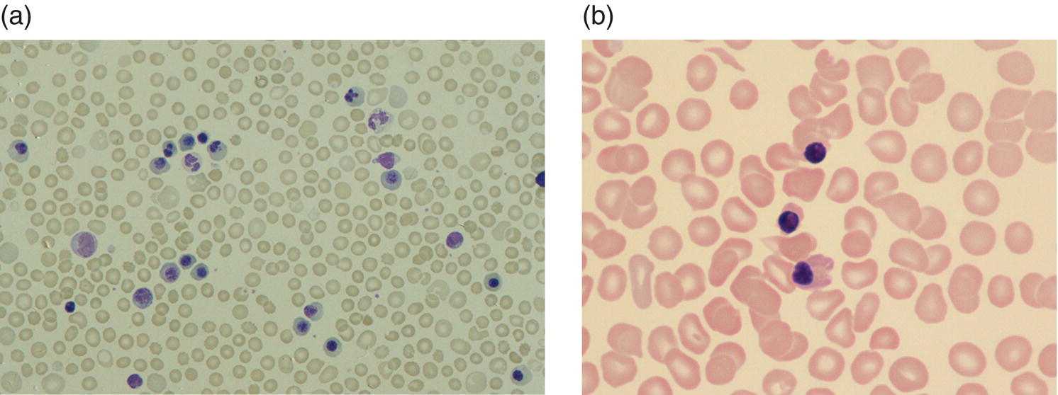 Photo depicts a blood film of two term neonates with anaemia secondary to fetomaternal haemorrhage showing (a) a very marked increase in erythroblasts and marked polychromasia on the first day of life and (b) three erythroblasts as well as an occasional spherocyte and mild polychromasia on day 3 of life.