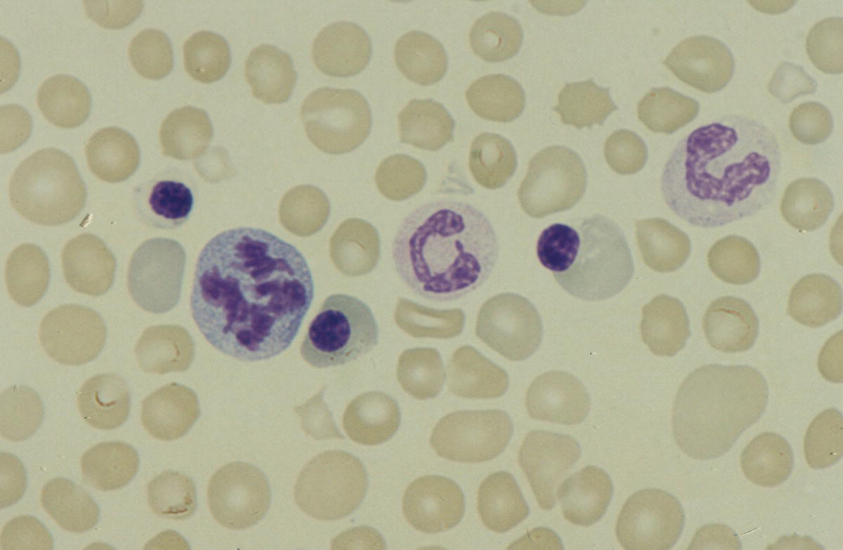 Photo depicts a blood film of a term neonate born with severe anaemia (Hb 50 g/l) showing three normoblasts, an erythroblast containing a mitotic figure, polychromasia and a mixture of normochromic and hypochromic red cells as well as some spherocytes.