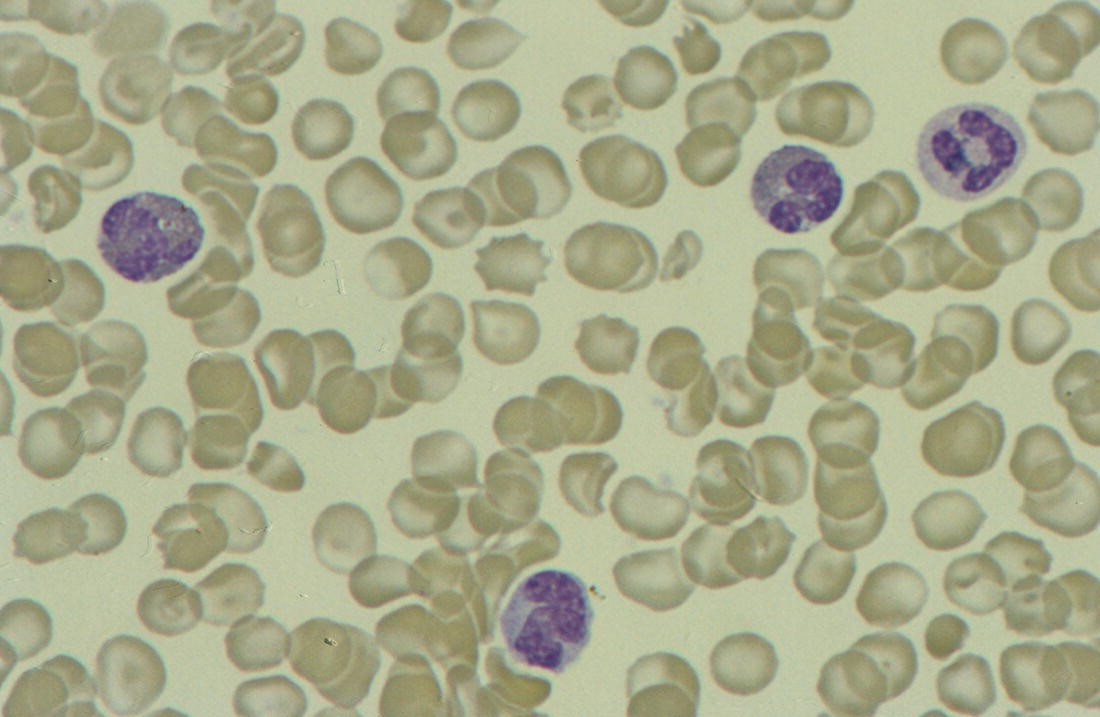 Photo depicts a blood film of a preterm neonate with eosinophilia showing two eosinophils and two neutrophils.