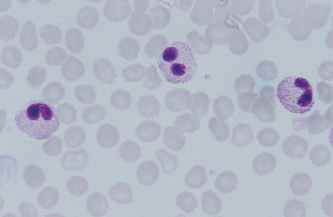 Photo depicts a blood film of a term neonate with Pelger–Huët anomaly showing three neutrophils with typical dumbbell-shaped nuclei.