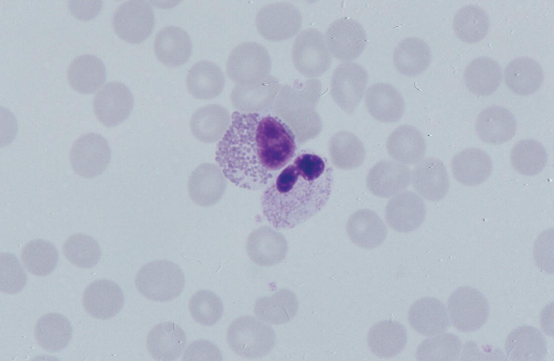 Photo depicts a blood film of a term neonate with Pelger–Huët anomaly showing a Pelger eosinophil with a rounded nucleus as well as a neutrophil with a typical dumbbell-shaped nucleus.