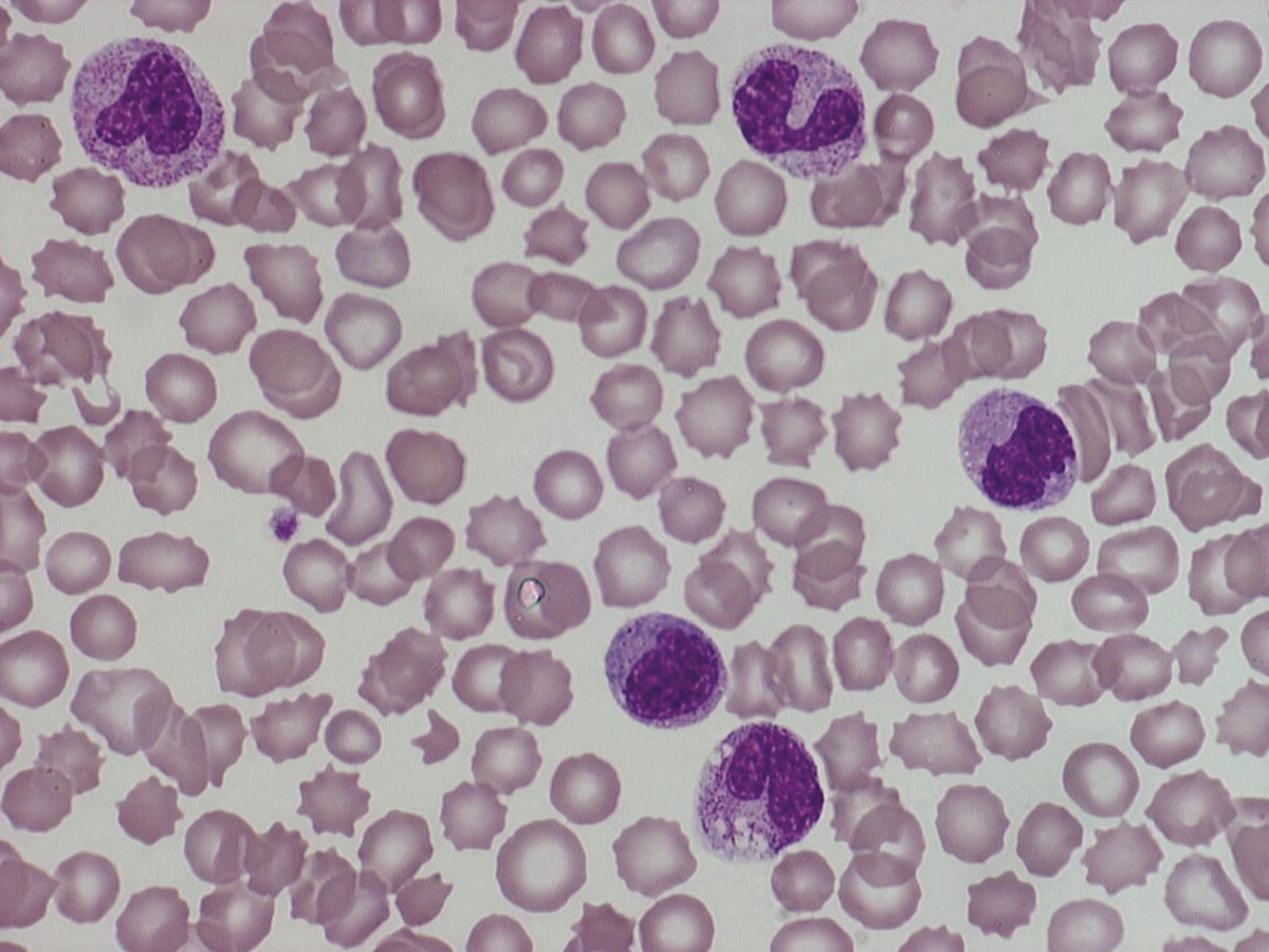 Photo depicts a blood film of a preterm neonate showing typical features of a Gram-negative bacterial infection: neutrophil toxic granulation, marked left shift and vacuolation.