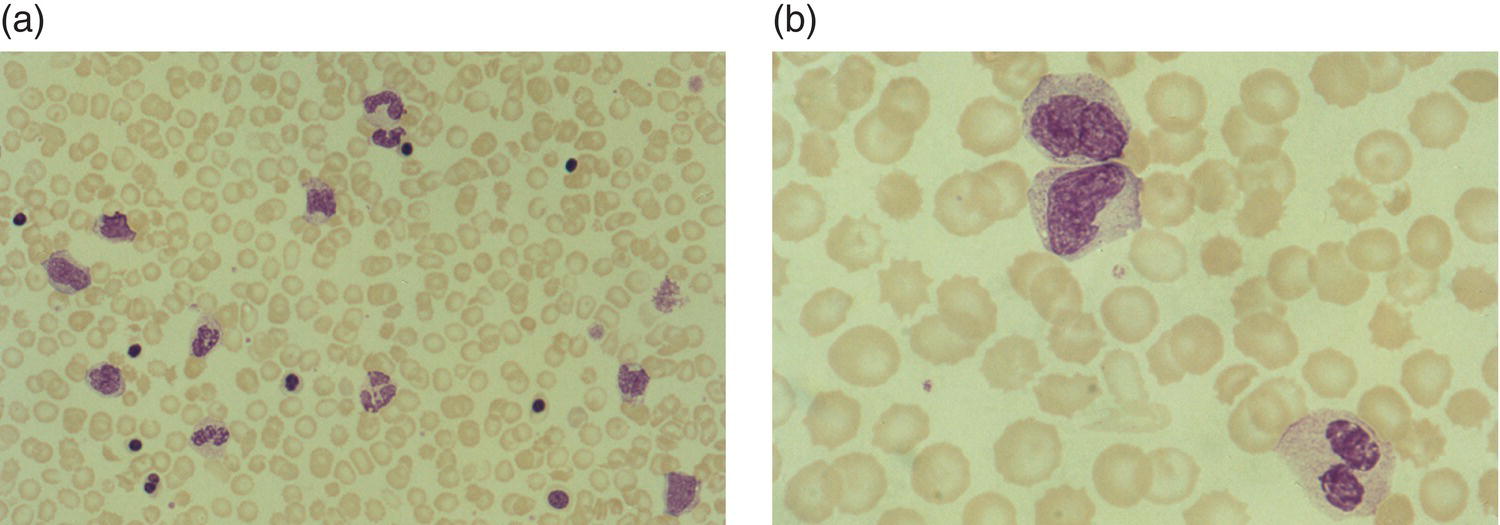 Photo depicts a blood film of a neonate with congenital Listeria monocytogenes infection showing peripheral blood monocytosis.