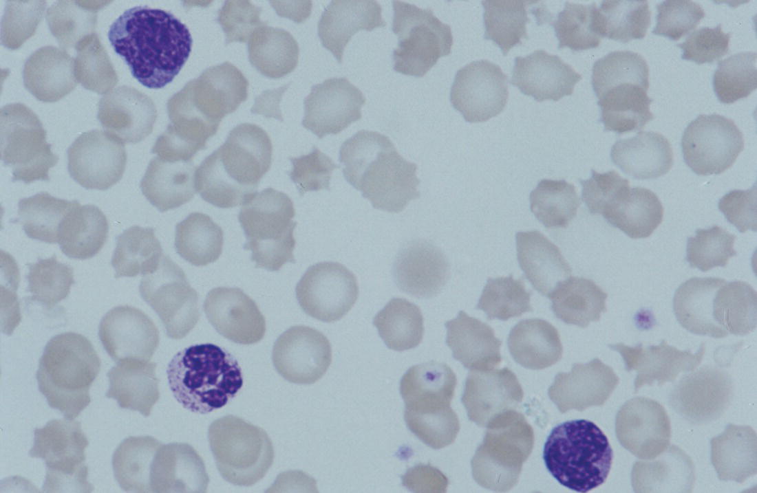 Photo depicts a blood film of a neonate with congenital toxoplasmosis showing atypical mononuclear cells.