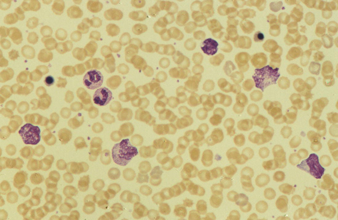 Photo depicts a blood film of a preterm neonate born at 26 weeks’ gestation with congenital pneumonia caused by Mycoplasma pneumoniae infection showing neutrophils and atypical mononuclear cells.