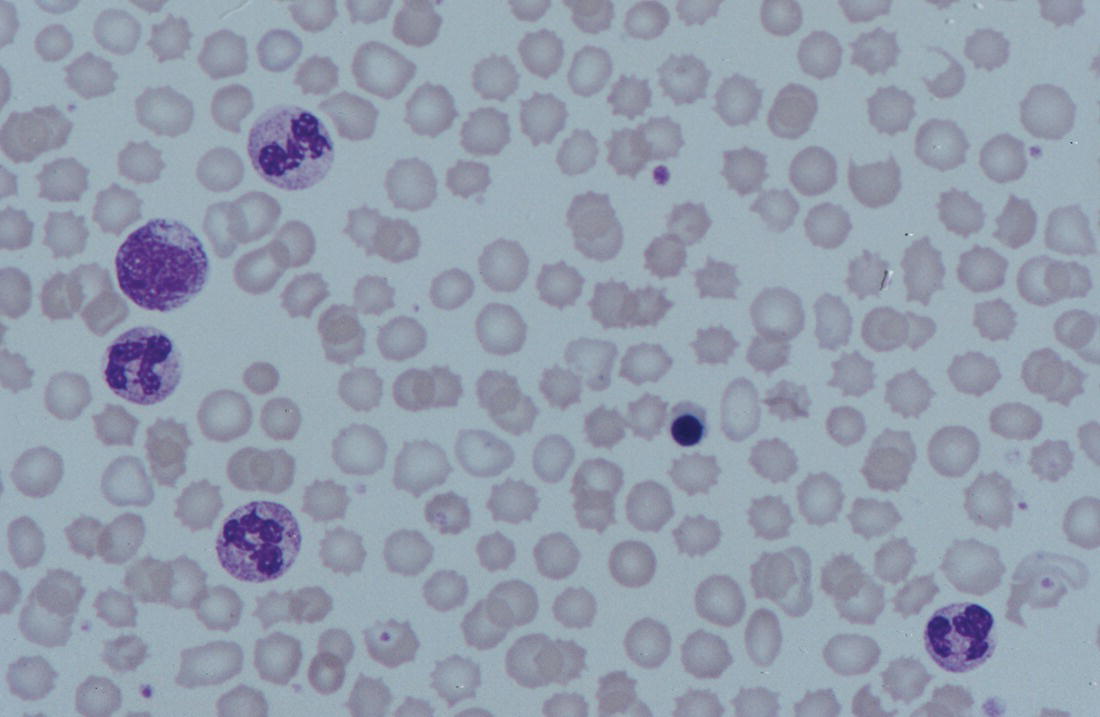 Photo depicts a blood film of a preterm neonate born at 27 weeks’ gestation and found to have hypoxic ischaemic encephalopathy showing toxic granulation of the neutrophils, a promyelocyte and nucleated red blood cells (NRBC).