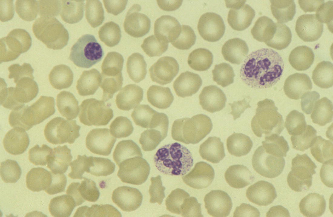 Photo depicts impact of maternal chorioamnionitis on the blood film at birth showing that toxic granulation of the neutrophils is already present.