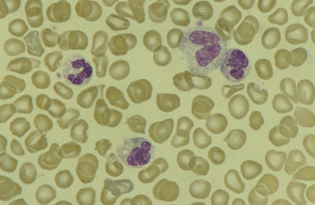 Photo depicts a blood film of a 3-week-old preterm neonate born at 29 weeks’ gestation who developed infection of an indwelling intravascular catheter with Staphylococcus epidermidis.