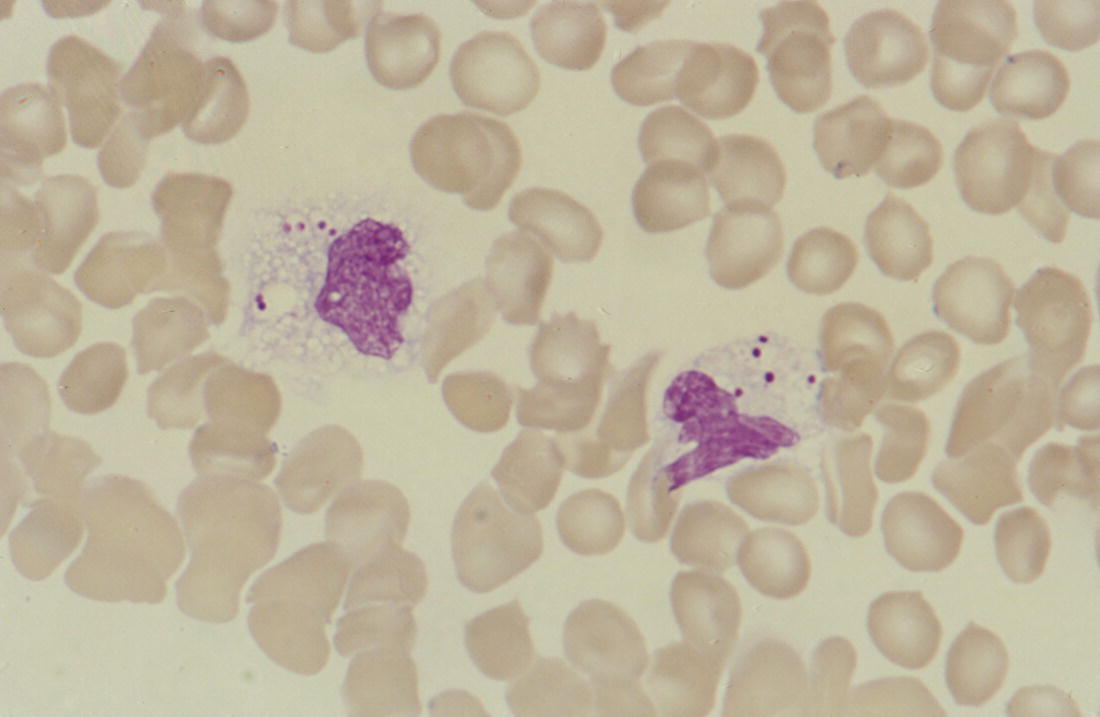 Photo depicts a blood film of a preterm neonate with Staphylococcus epidermidis infection showing the presence of the organisms within two monocytes.