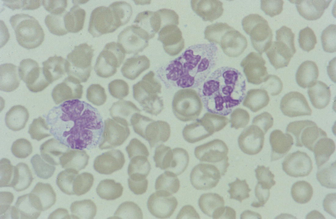 Photo depicts a blood film of a neonate with Candida infection showing neutrophil and monocyte vacuolation.