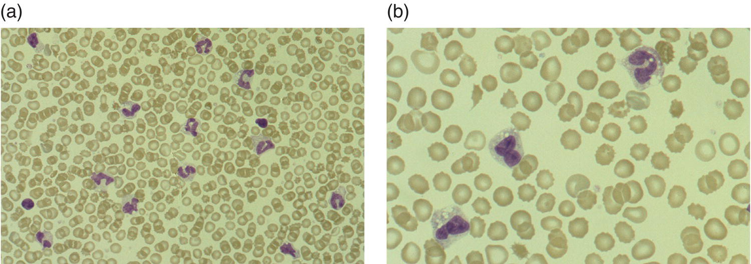 Photo depicts a blood film of a preterm neonate with necrotising enterocolitis showing vacuolation of the neutrophils and monocytes, which usually appears as one or more rounded punched out ‘holes’ in the cytoplasm of these cells: MGG, (a) ×40, (b) ×100.