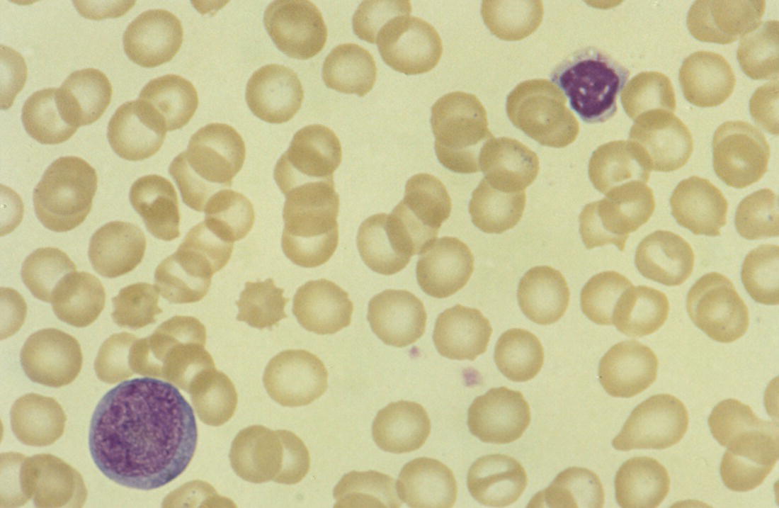 Photo depicts a blood film of a neonate with congenital cytomegalovirus (CMV) infection showing the presence of typical activated lymphocytes.