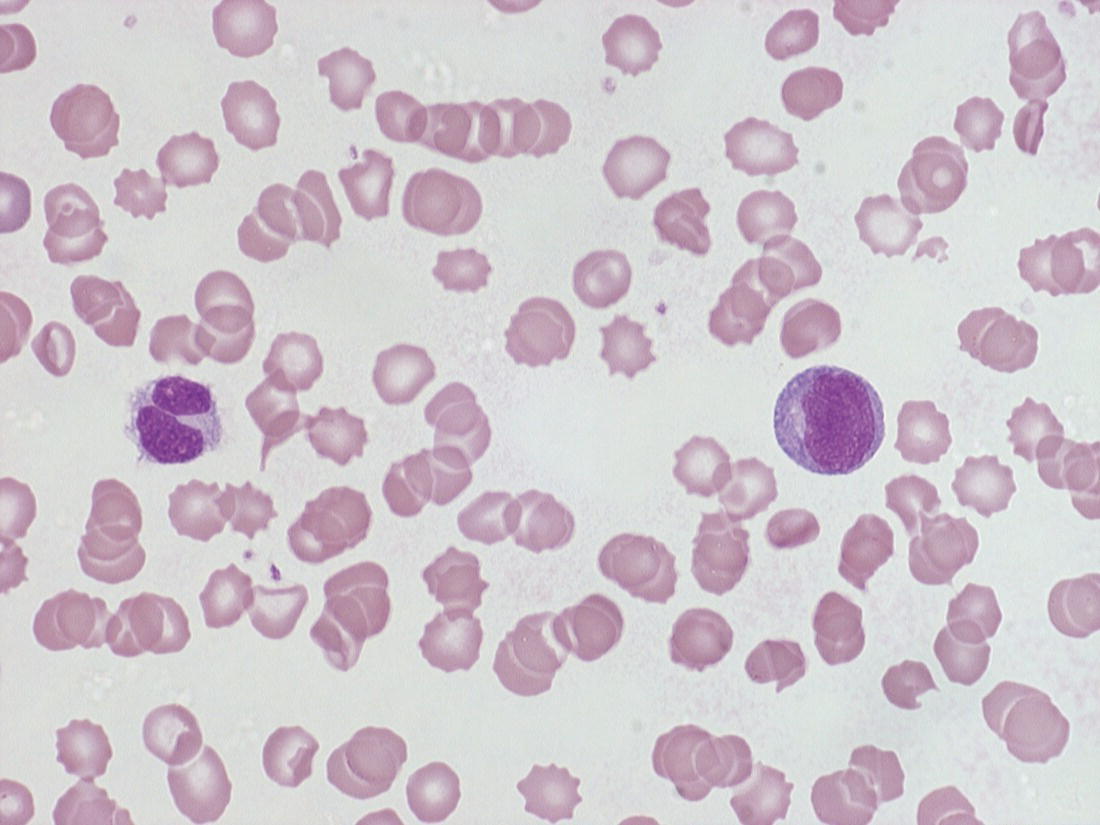 Photo depicts a blood film of a preterm neonate with congenital infection with coxsackievirus showing a large lymphocyte with deeply basophilic cytoplasm and a second cell that may be a binucleated reactive lymphocyte.