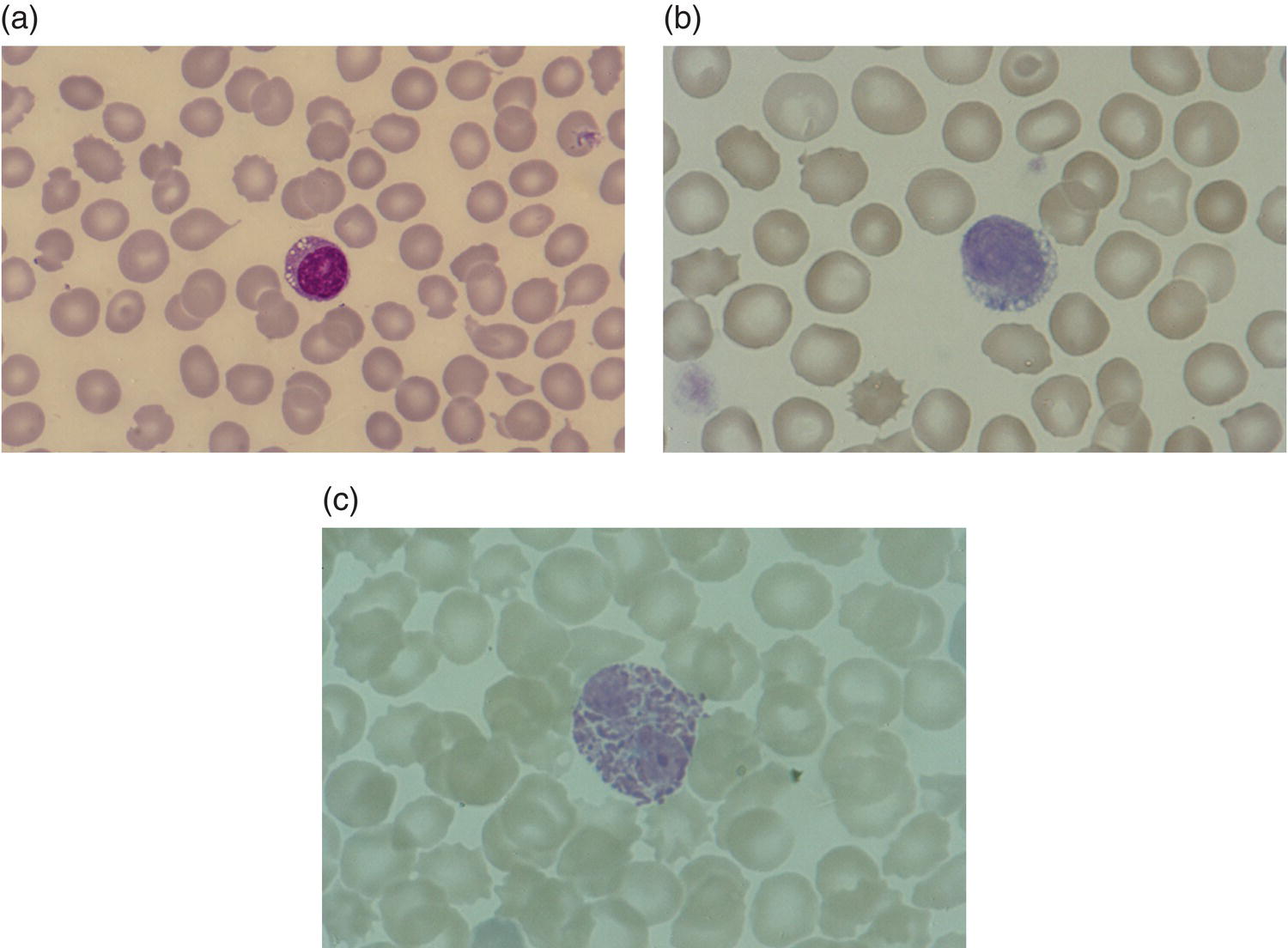 Photo depicts blood films in storage disorders: (a) lymphocyte vacuolation in Wolman disease; (b) lymphocyte vacuolation in beta-galactosidase deficiency; (c) Alder–Reilly bodies in a neutrophil in Sly disease.