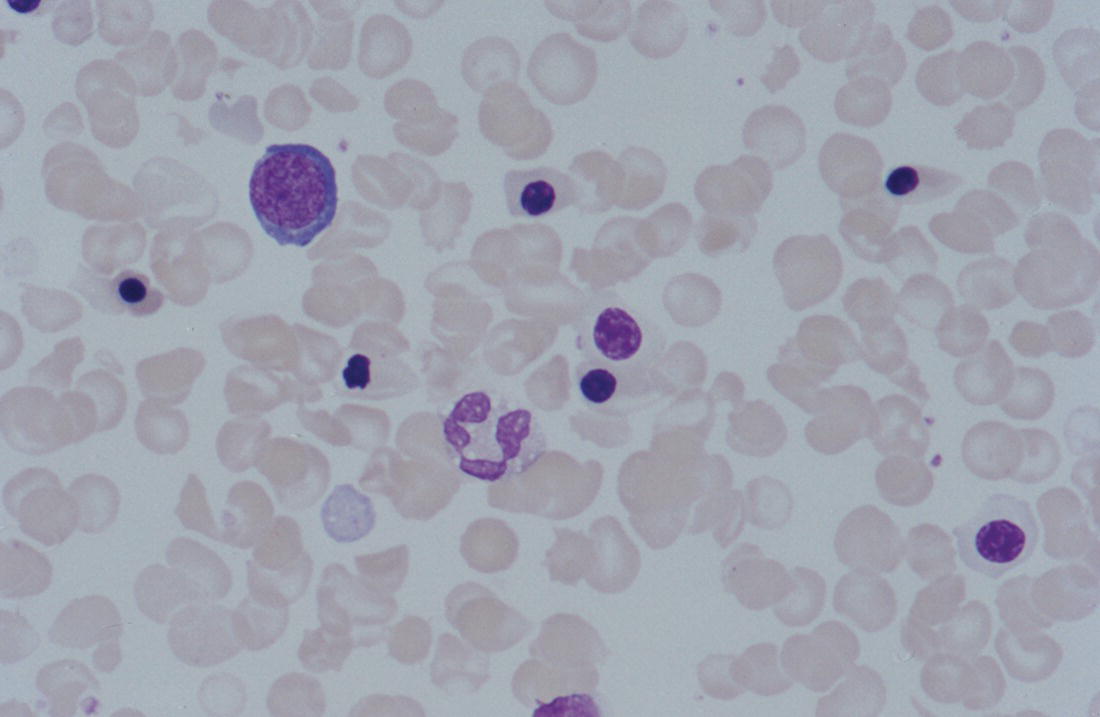 Photo depicts a blood film of a preterm neonate with IUGR showing increased numbers of normoblasts and a basophilic erythroblast.