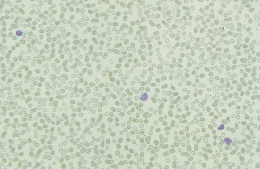 Photo depicts a blood film of a 3-week-old term neonate with severe congenital neutropenia (SCN) showing two monocytes and two lymphocytes (note the absence of neutrophils on this low power view).