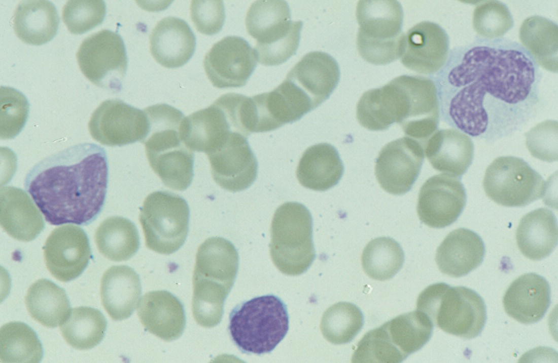 Photo depicts a blood film of a neonate with SCN during an acute infection showing a monocyte and promonocyte, as well as a lymphocyte, but no neutrophils.