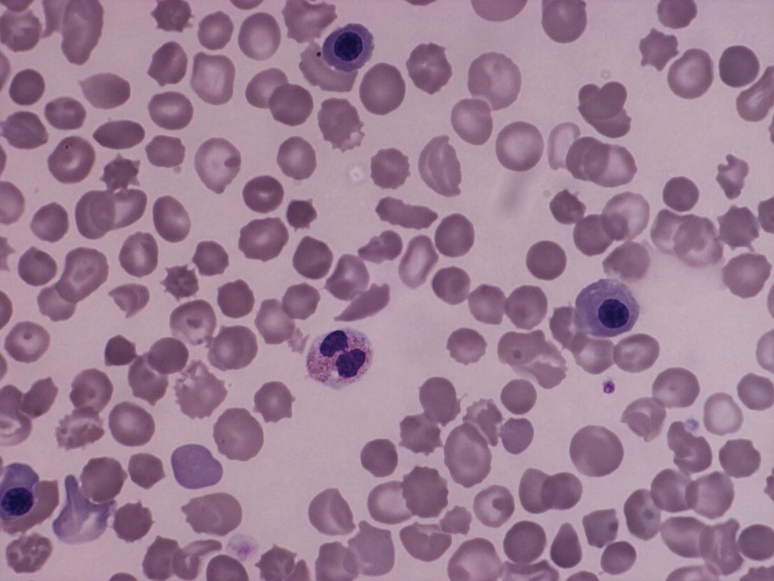 Photo depicts a blood film of a neonate with Down syndrome showing increased erythroblasts, target cells and macrocytes as well as some spherocytes and echinocytes.