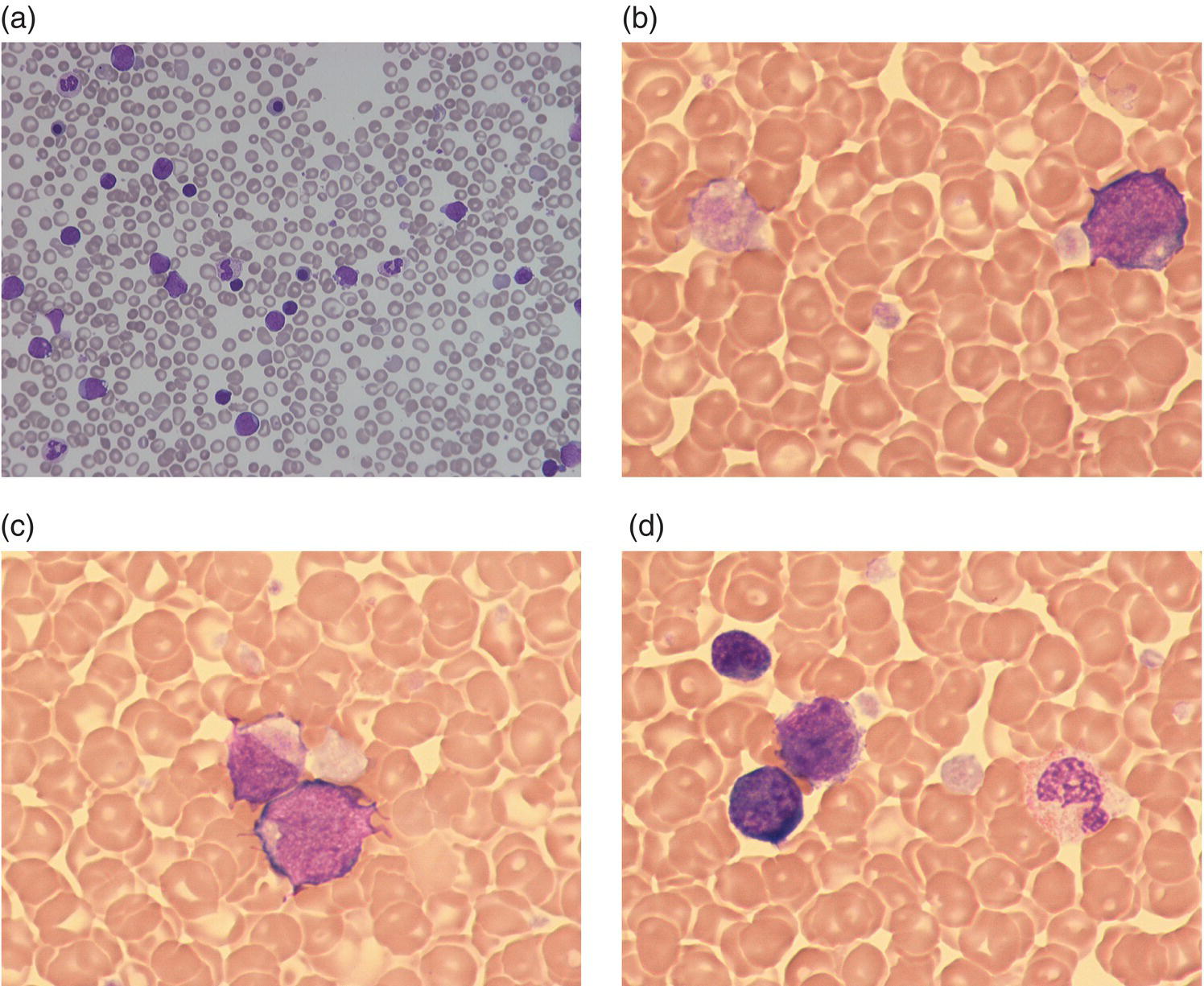 Photo depicts blood films of neonates with Down syndrome with TAM.