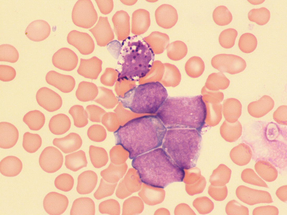 Photo depicts a blood film of a term neonate with Down syndrome and TAM showing six blast cells including one with basophilic granules and prominent vacuoles.