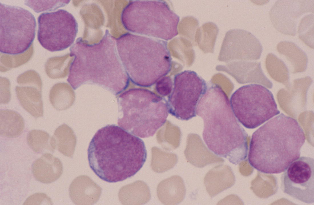 Photo depicts a blood film of a newborn with congenital AML showing large numbers of myeloblasts and two normoblasts.