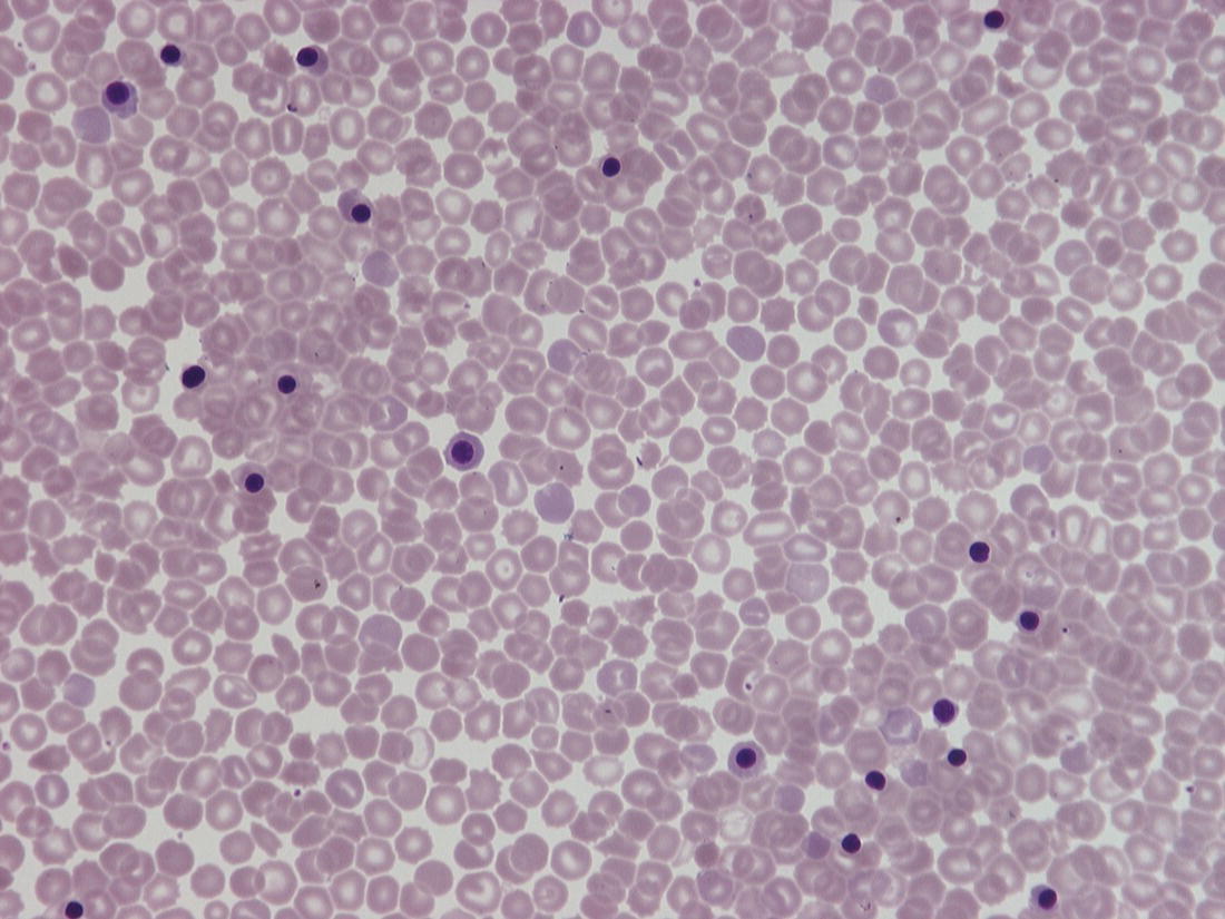 Photo depicts a blood film of a preterm neonate with intrauterine growth restriction showing erythroblastosis, polychromasia, poikilocytosis and target cells.