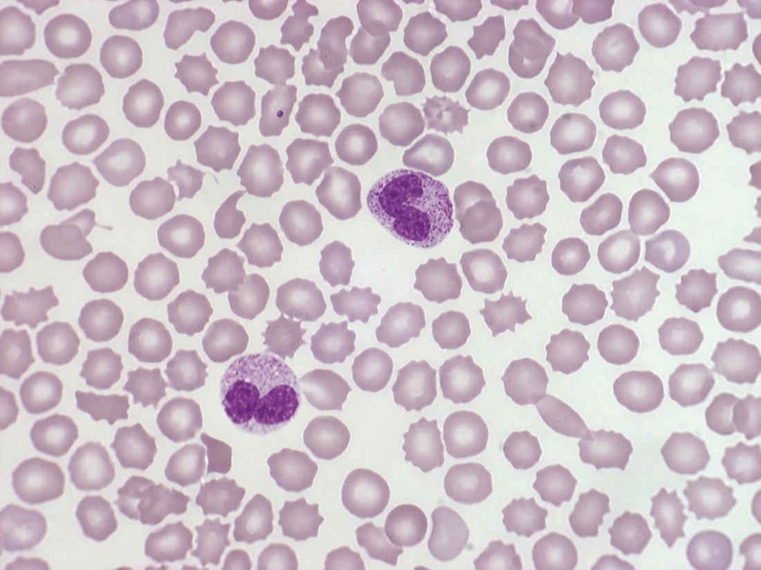 Photo depicts a blood film of a preterm neonate during an acute bacterial infection showing two neutrophils with toxic granulation and some schistocytes together with thrombocytopenia consistent with disseminated intravascular coagulation.