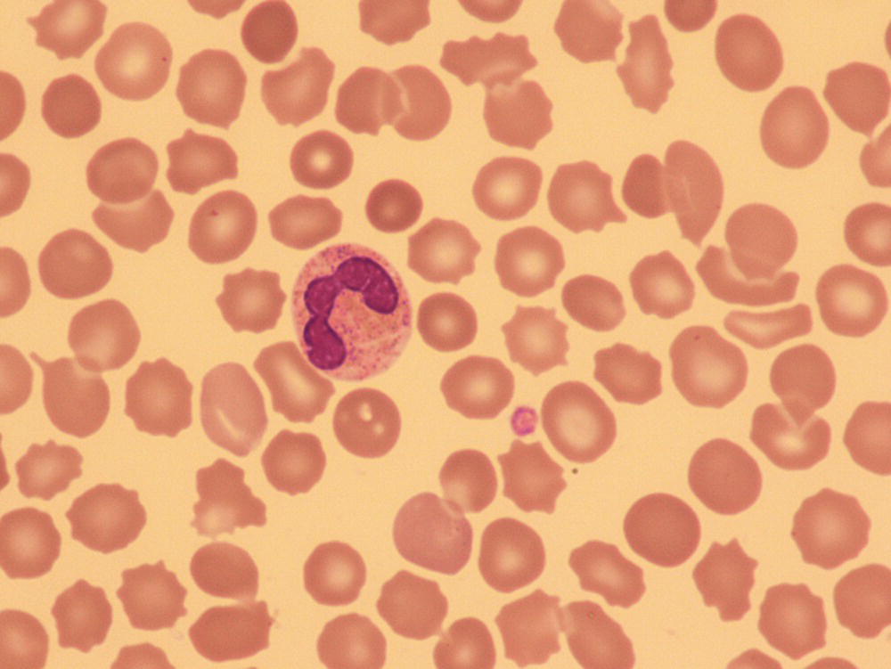 Photo depicts a blood film of a neonate born at 36 weeks’ gestation with severe thrombocytopenia due to fetal/neonatal alloimmune thrombocytopenia showing a single normal-sized platelet as well as a normal neutrophil and red cells.