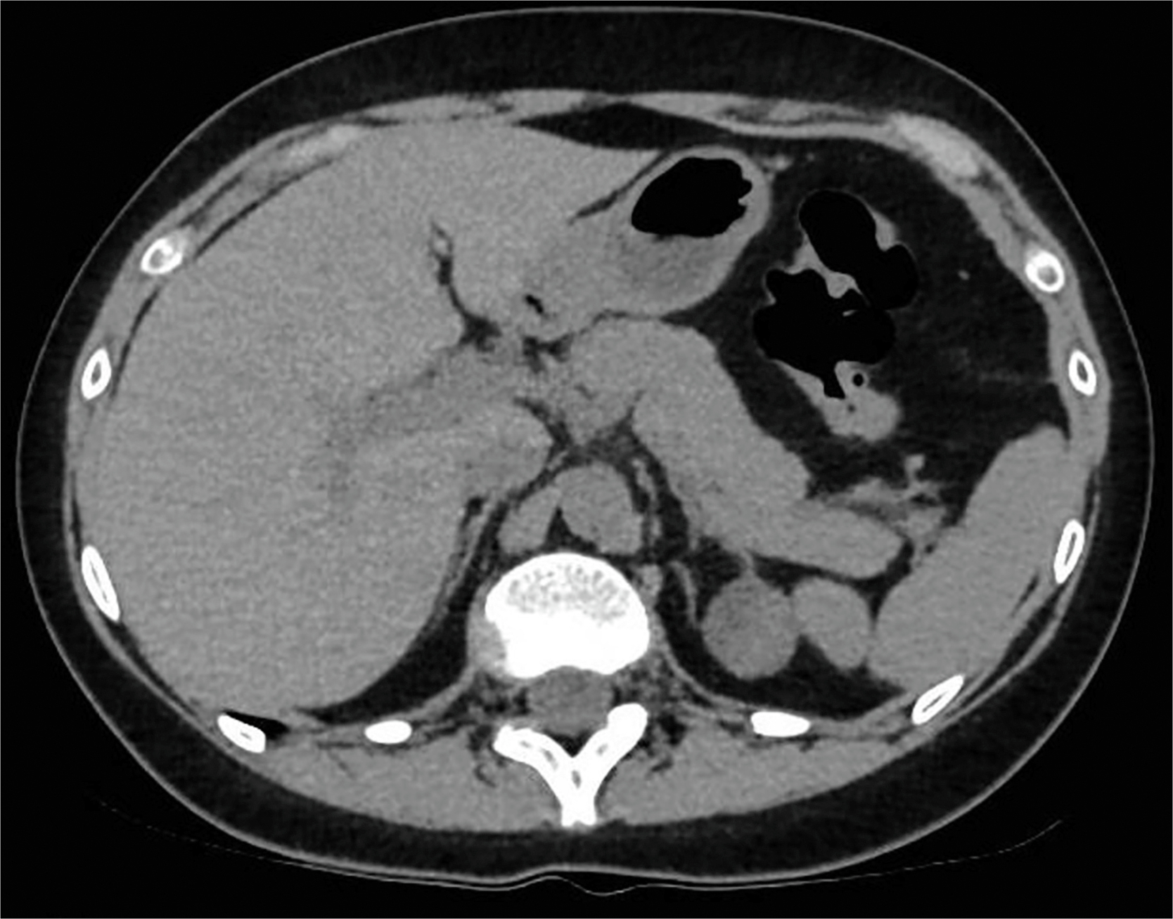 An axial C T scan cross section of the upper abdomen with the liver on the left, gas filled bowel on the right, a central vertebral body, and surrounding soft tissues.