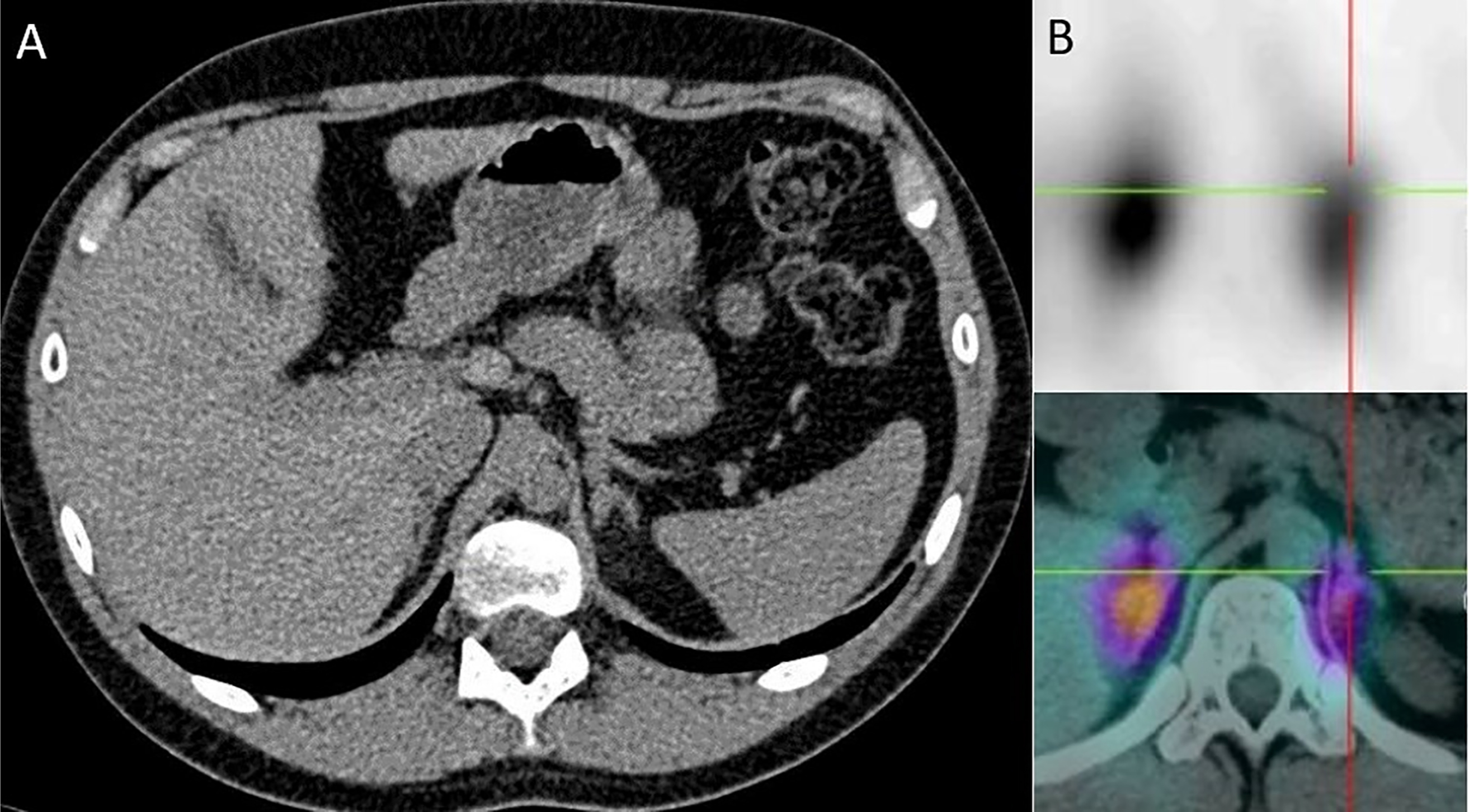A multi panel medical scan layout with panel A displaying an axial C T scan of the upper abdomen and panel B displaying aligned nuclear medicine slices with reference lines.
