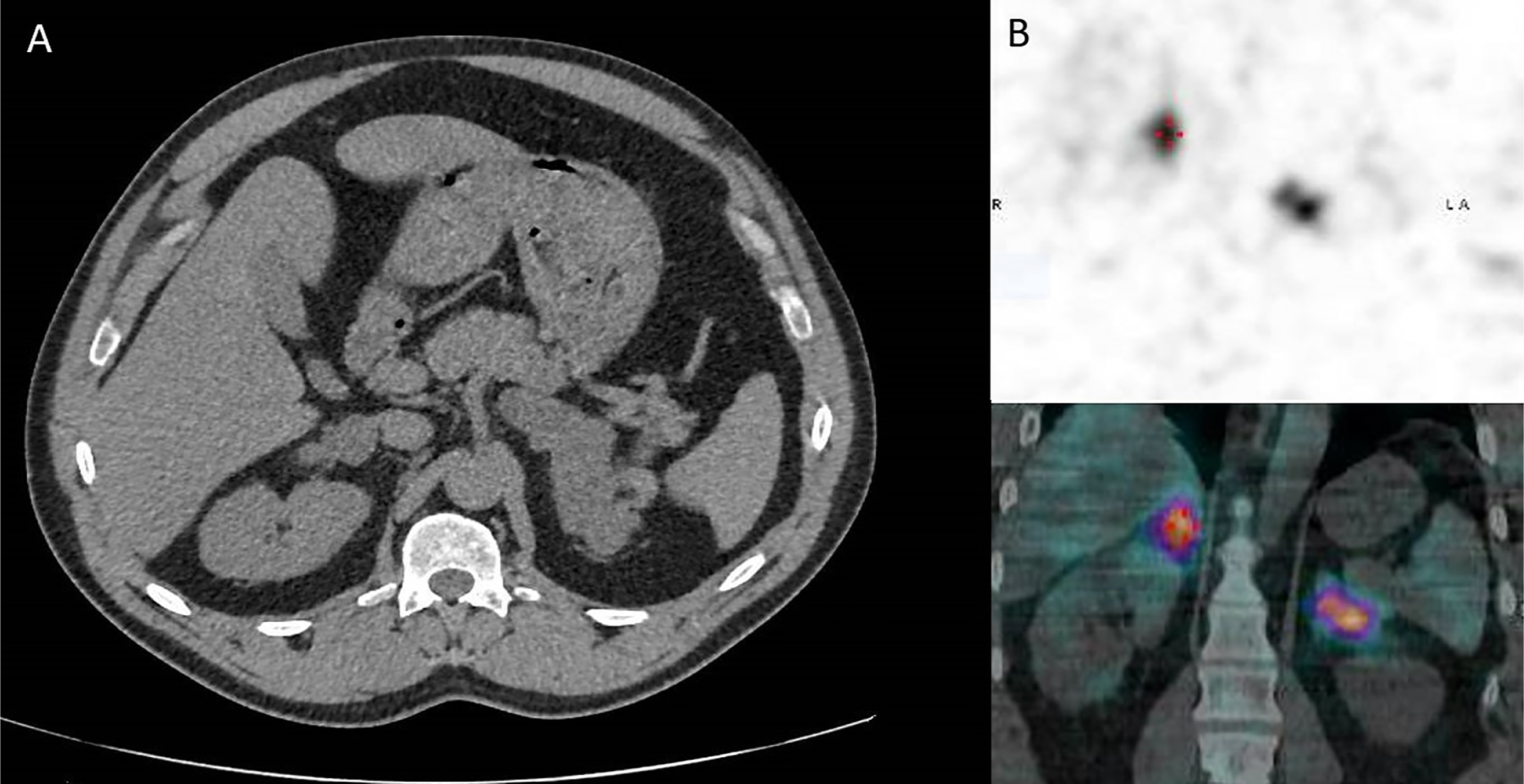 A multi panel medical scan layout with panel A displaying an axial C T scan of the abdomen and panel B displaying aligned nuclear medicine slices with reference lines.
