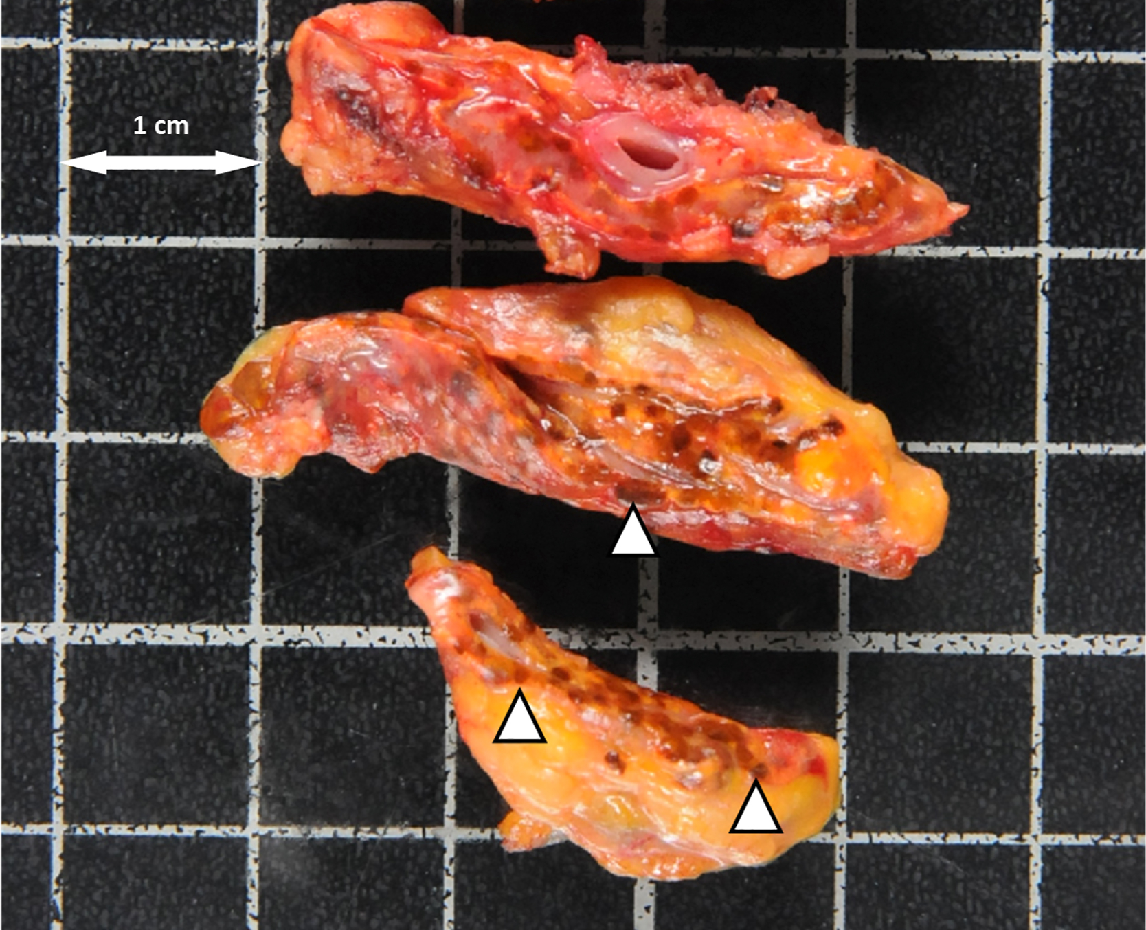 A gross specimen layout with three elongated soft tissue specimens on a gridded surface, a 1 centimetre scale arrow, and triangular markers on the middle and lower specimens.