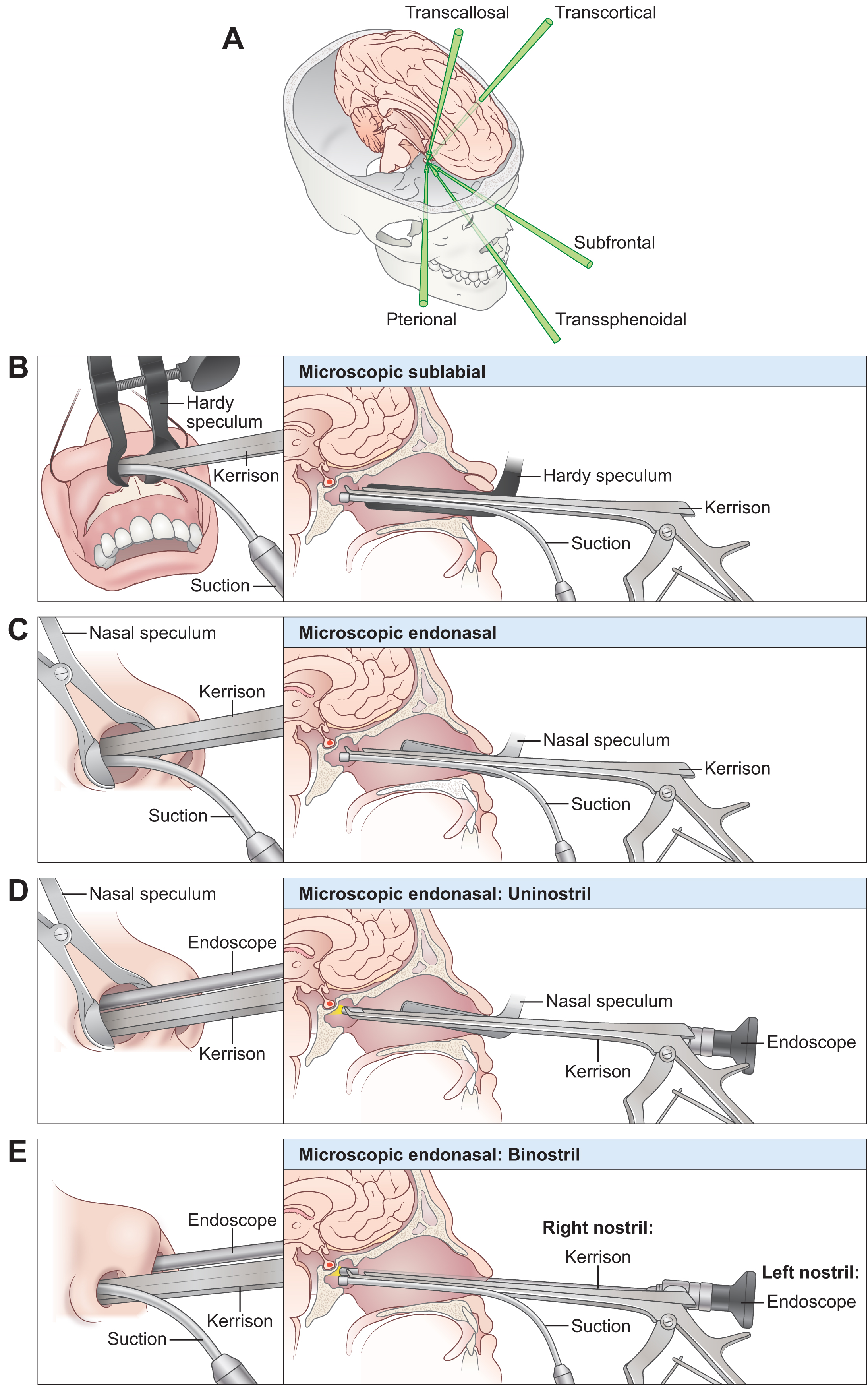 An illustration of pituitary surgical approaches with panels A to E including transcallosal, transcortical, subfrontal, pterional, transsphenoidal, and endonasal methods.